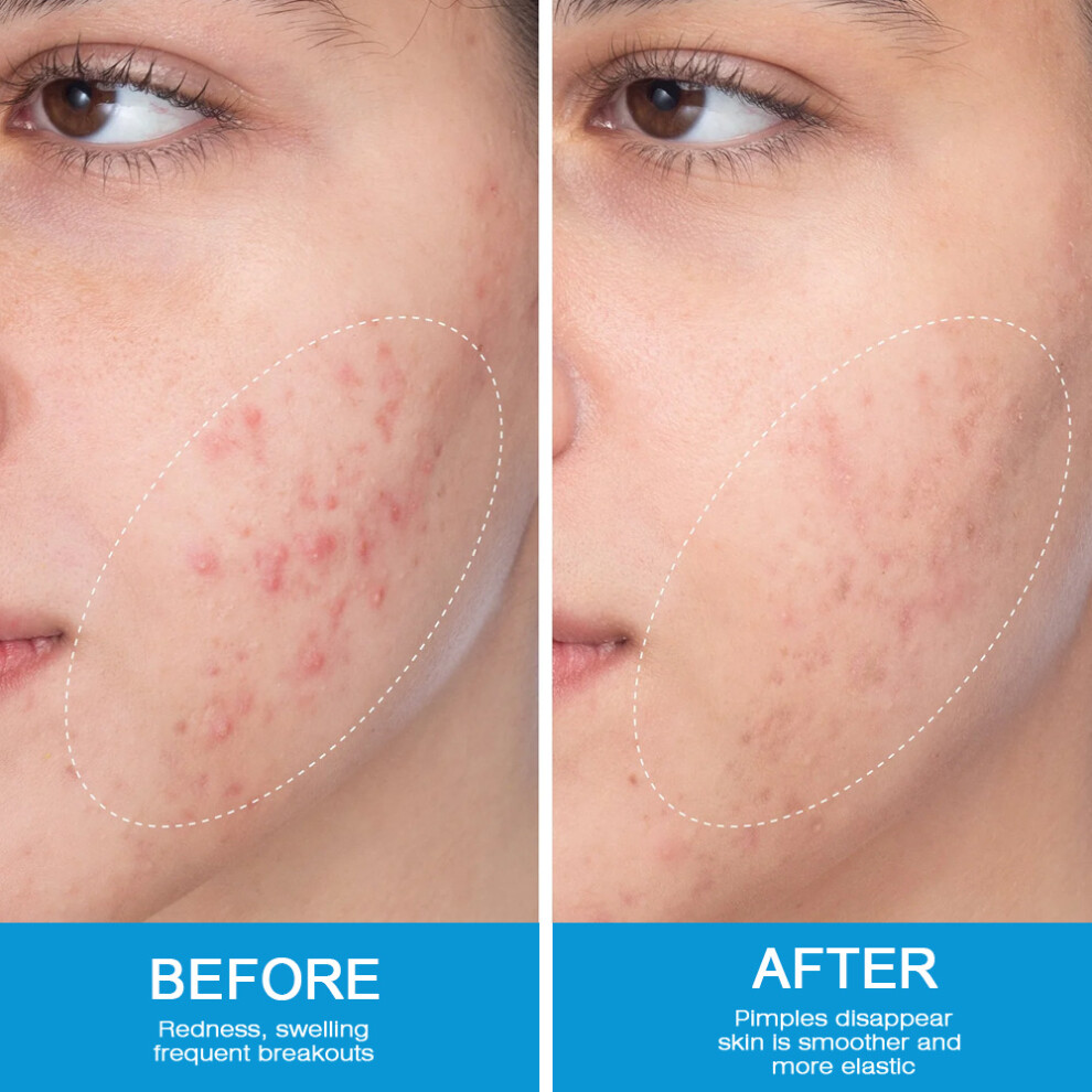 20g External skin care cream acne skin cream skincare