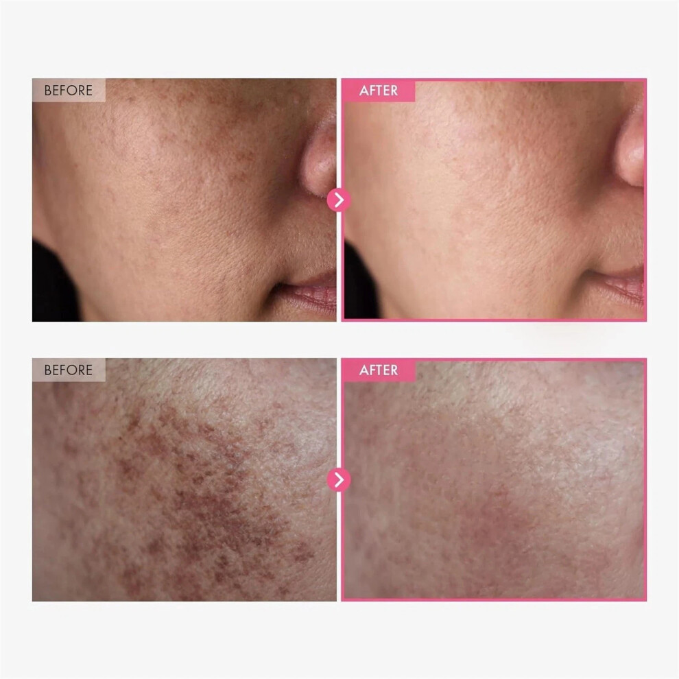Arbutin 7Percent Tranexamic Acid 4Percent Cream Brightening Beauty Skin