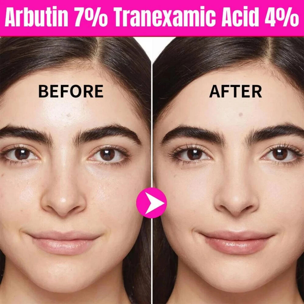 Arbutin 7Percent Tranexamic Acid 4Percent Cream Brightening Beauty Skin