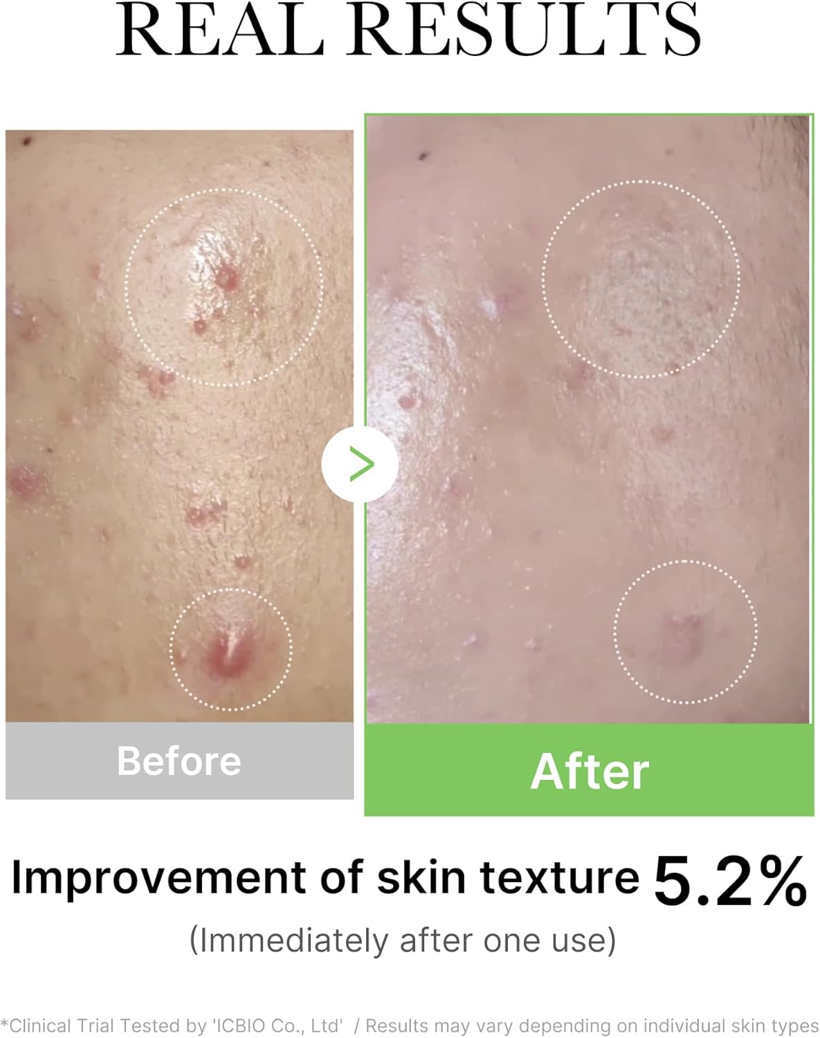 medicube Exosome Cica Tea Tree Ampoule for Sensitive Skin with Centella Asiatica Helps Reduce Redness Breakouts Moisturizing Soothing Serum Korean Skincare 30ml