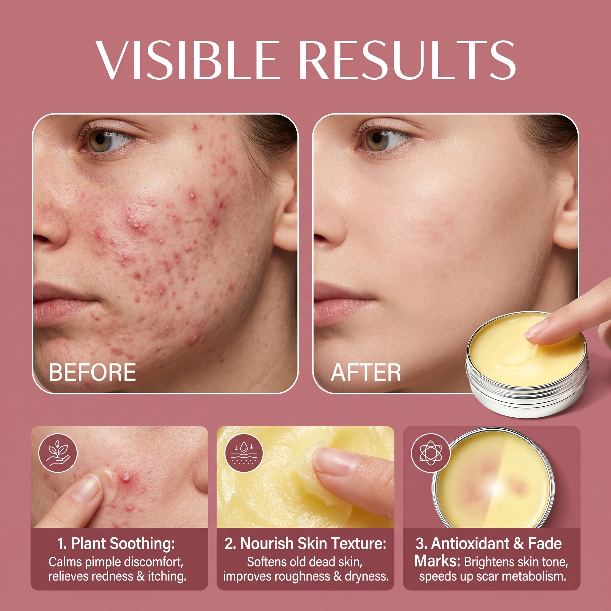 Acne Skin Ointment Herbal Plant Extract Formula Mild Moisturizing Smooth Refreshing Clean Facial Acne Skin Care