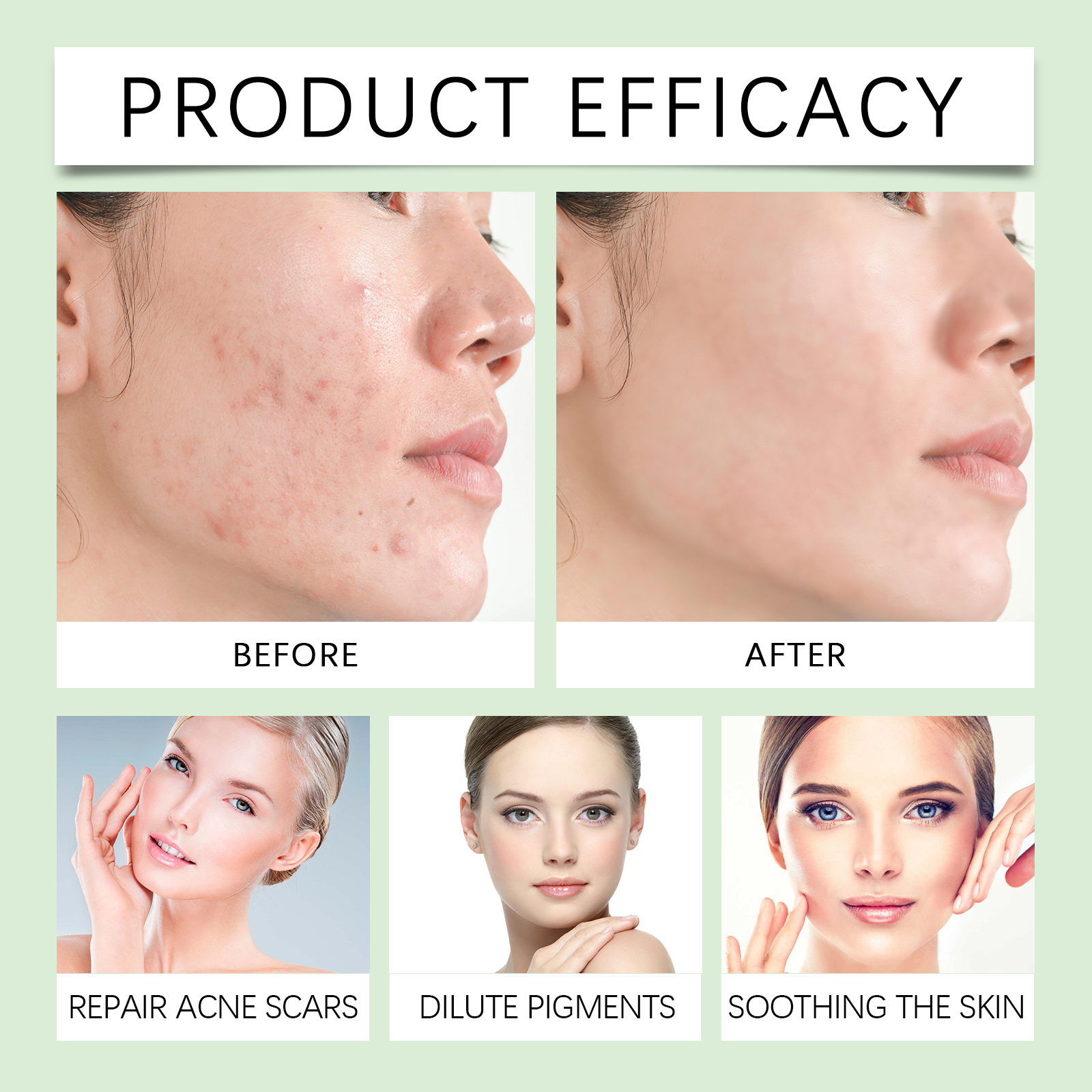 Skin Care Cream Mild Body Clean Remove Acne Pimple Moist Soft Daily External