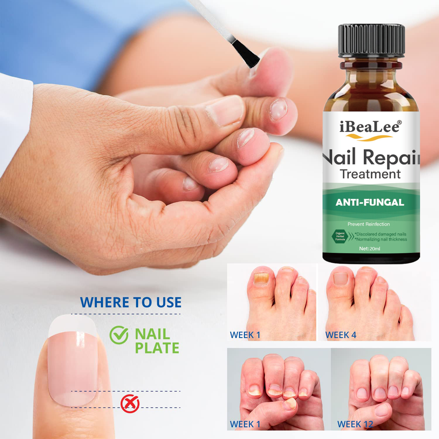 iBeaLee Nail Fungus Treatment Solution Liquid Toenail Feet Care Oil Anti-Infective Essence Paronychia Onychomycosis Repair Serum 20ml