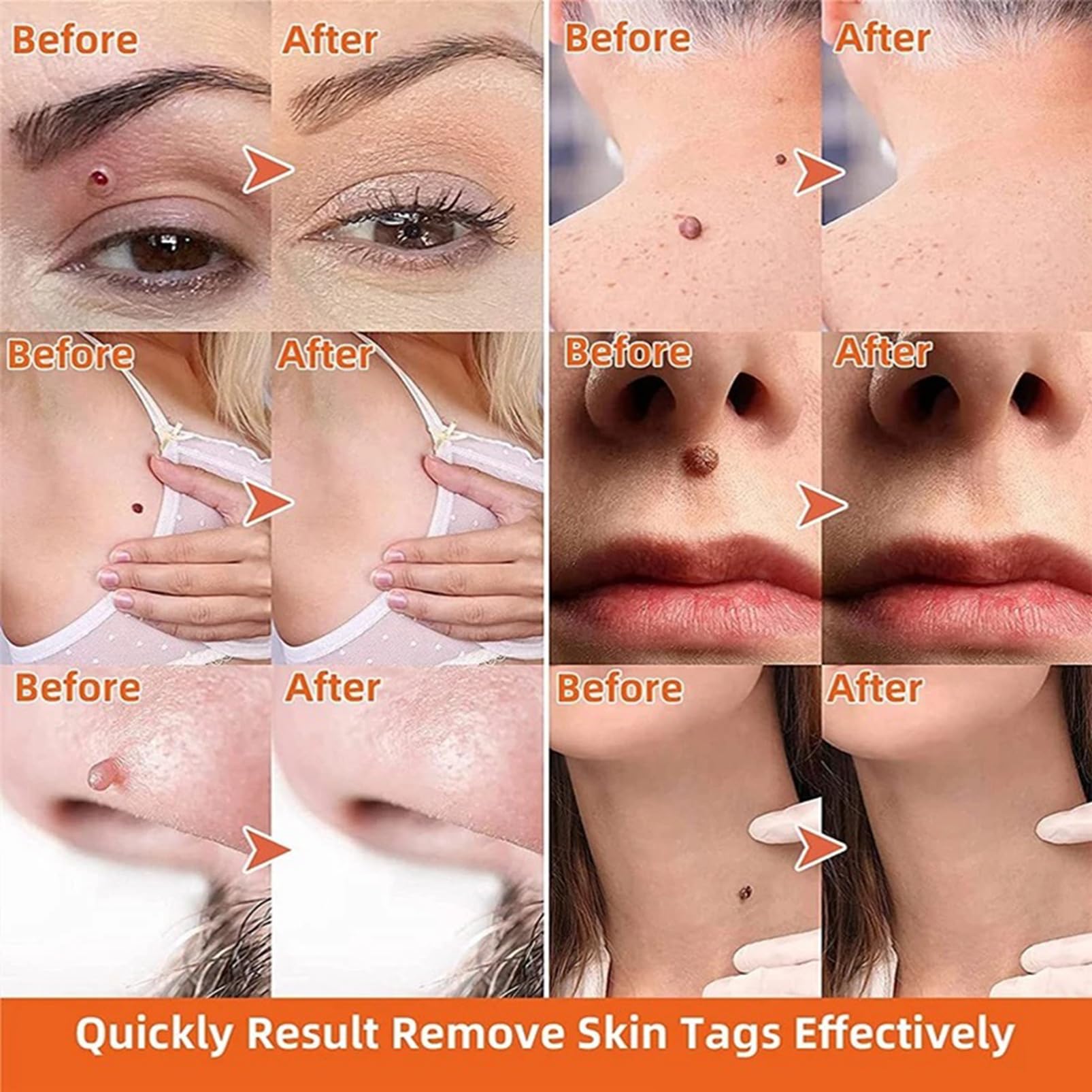 (1 pc) Skin Tag Remover Cream Painless Mole Skin Dark Spot Warts Remover Natural Skin Tag Mole Removal for Face and Body