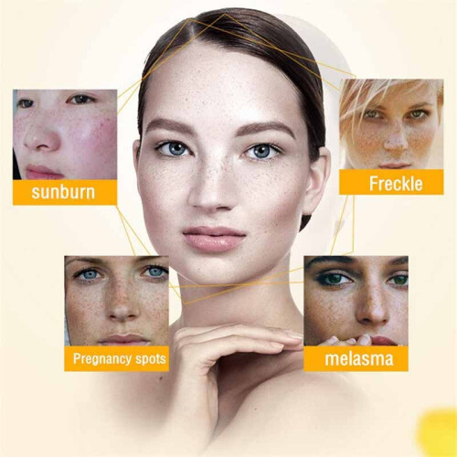 Whitening Freckle Cream Remove Melasma Acne Dark Spot Skin Care 20ml