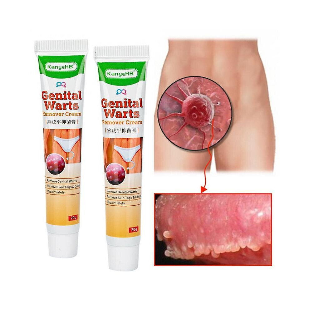 Wart Remover Ointment Vulva Herpes Condyloma Acuminatum Skin Tag Painless
