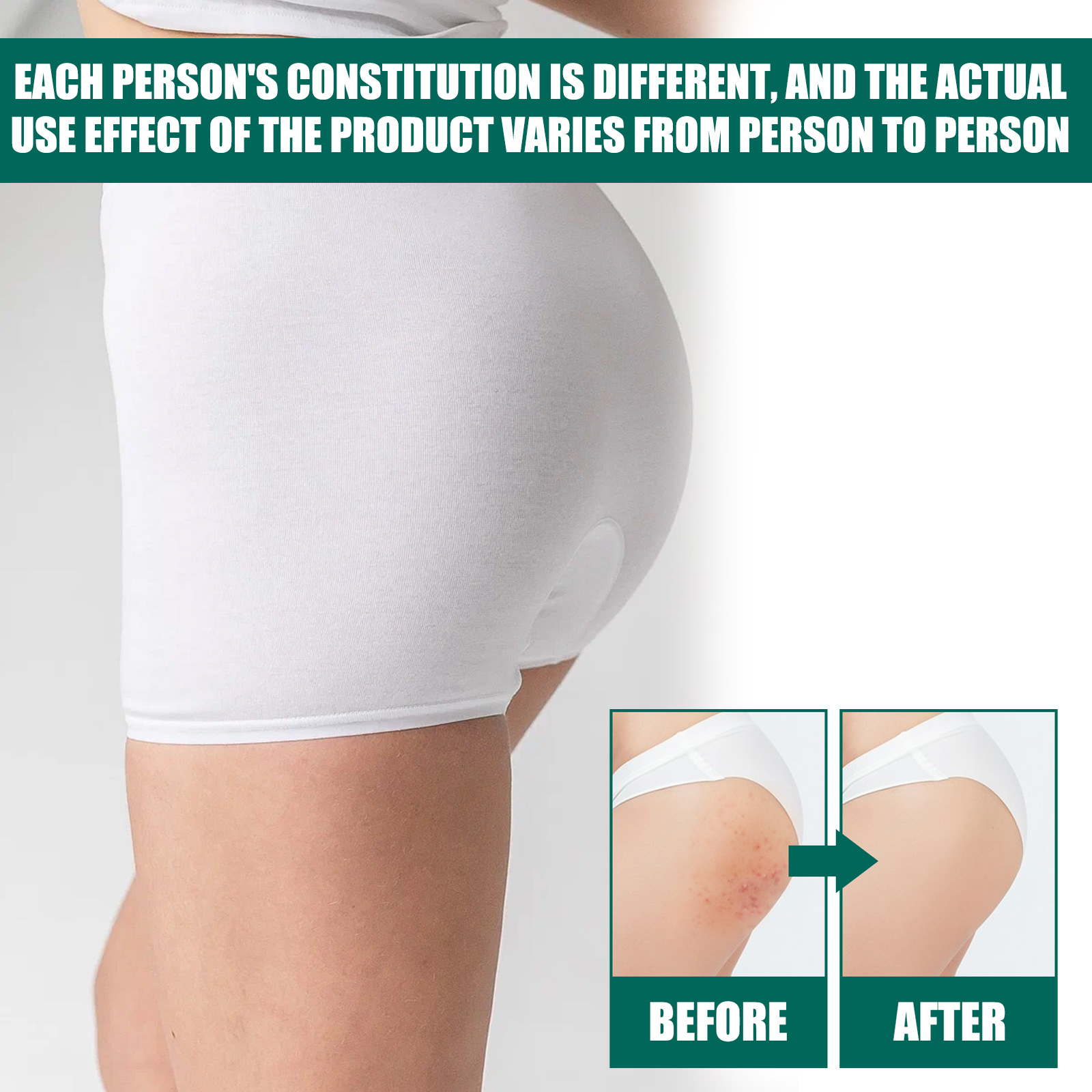 Jaysuing Butt Acne Treatment Cream Clearing Buttock Thigh Acne Bumps Dark Spots Moisturizing Smoothing Hydrating Body Care