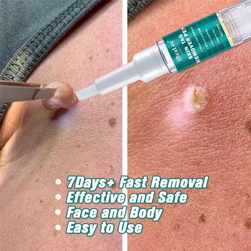iBeaLee Skin Tag Remover Tagwort Removal 7 Days 5ml