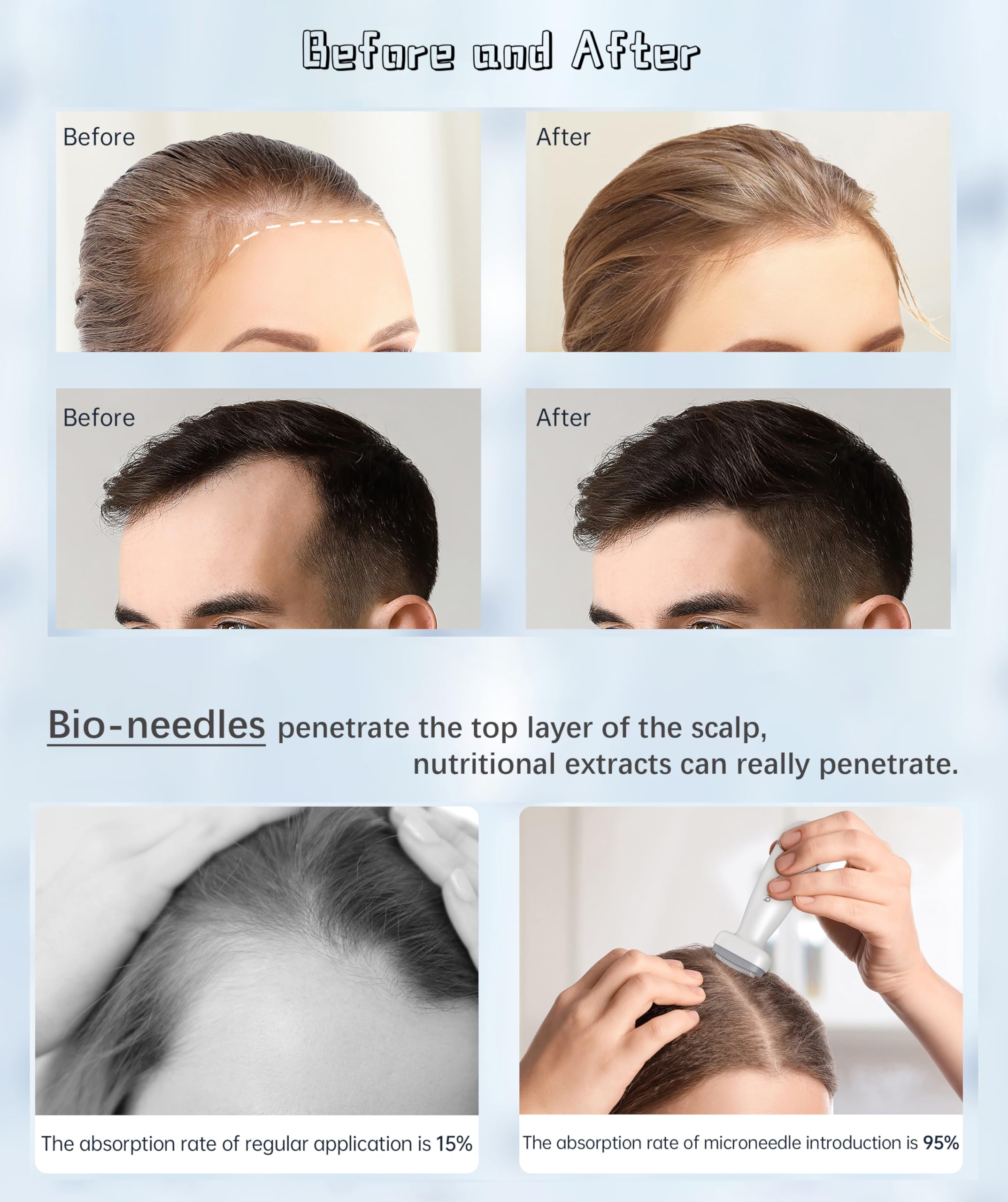Dr. Pen Bioneedle Derma Stamp Adjustable 0~2mm 120 Pins Derma Stamp Microneedling Derma Roller for Hair Beard Growth Loss Shrink Pores Brighten Skin Tone