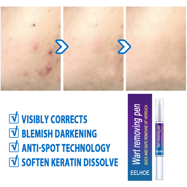 Wart Removing Pen Targeted Skin Care Pen Precise Application Skin Smoothing