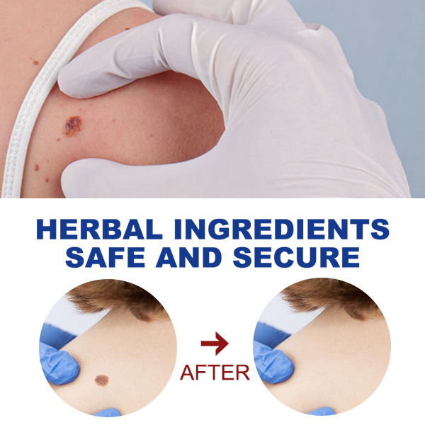 Wart Removing Pen Targeted Skin Care Pen Precise Application Skin Smoothing
