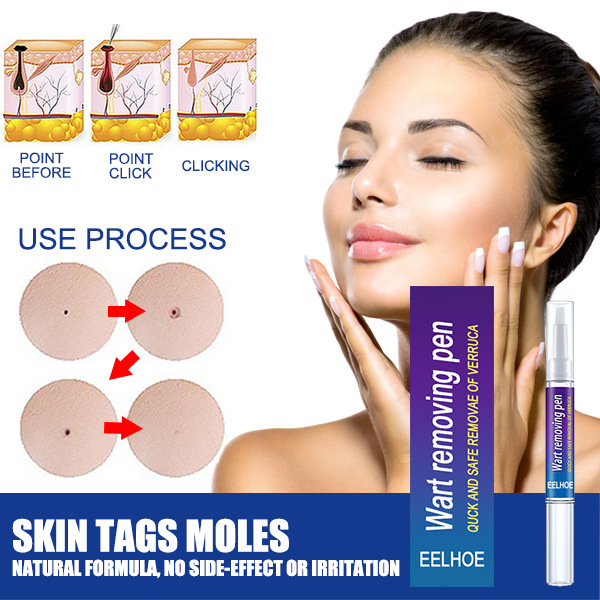 Wart Removing Pen Targeted Skin Care Pen Precise Application Skin Smoothing