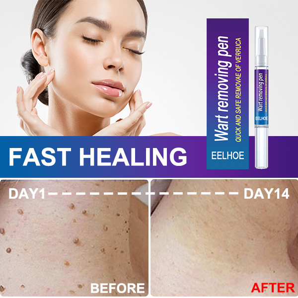Wart Removing Pen Targeted Skin Care Pen Precise Application Skin Smoothing