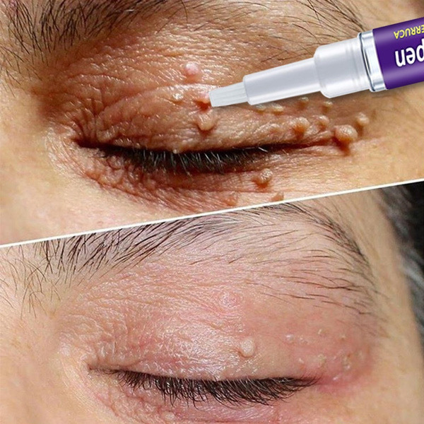 Wart Removing Pen Targeted Skin Care Pen Precise Application Skin Smoothing