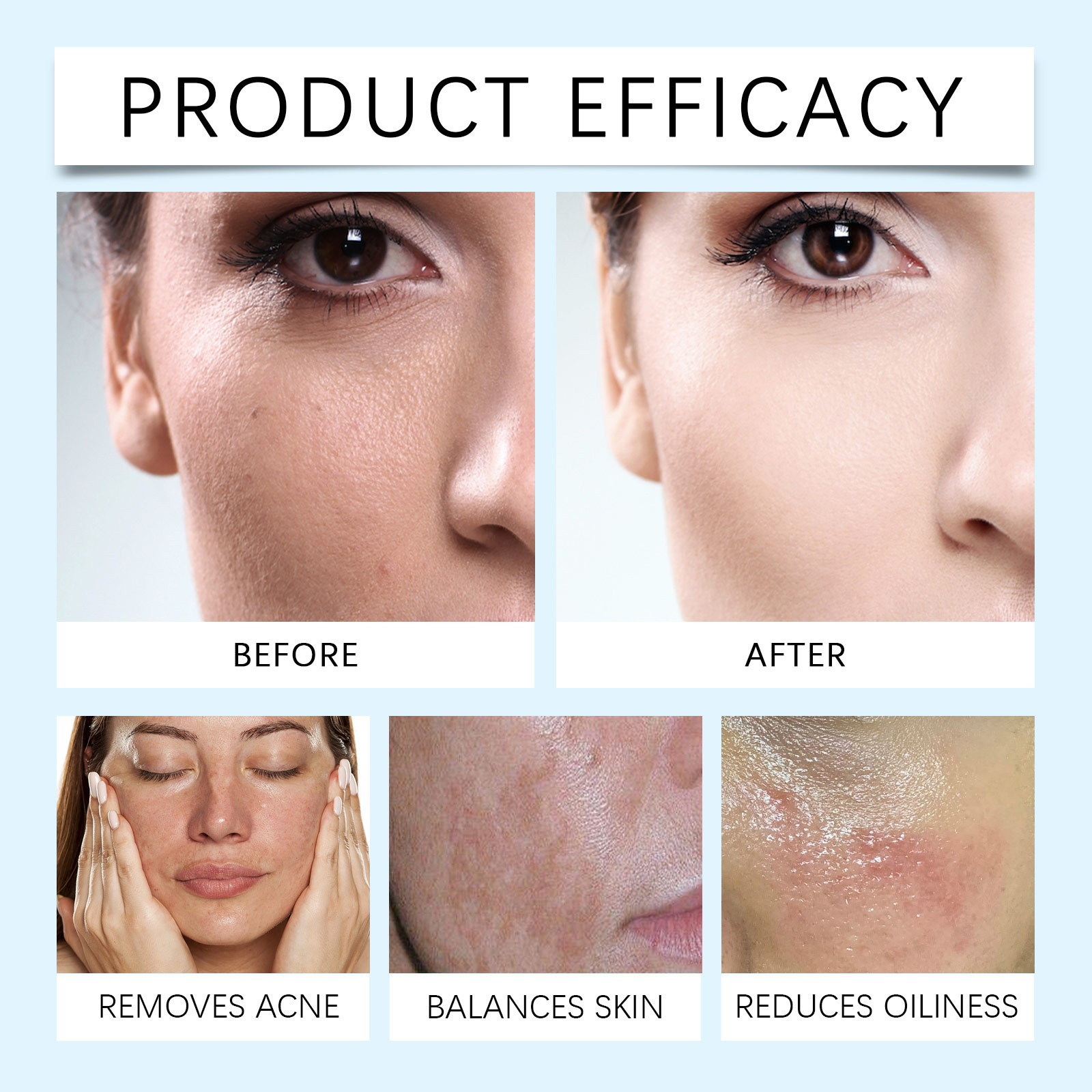 WOODSLEEP Acne Night Cream Face Cream Skin Oil Moisturizing Repair Pimple Fade Mark Deep Cleaning  Improve Large Pores 50g