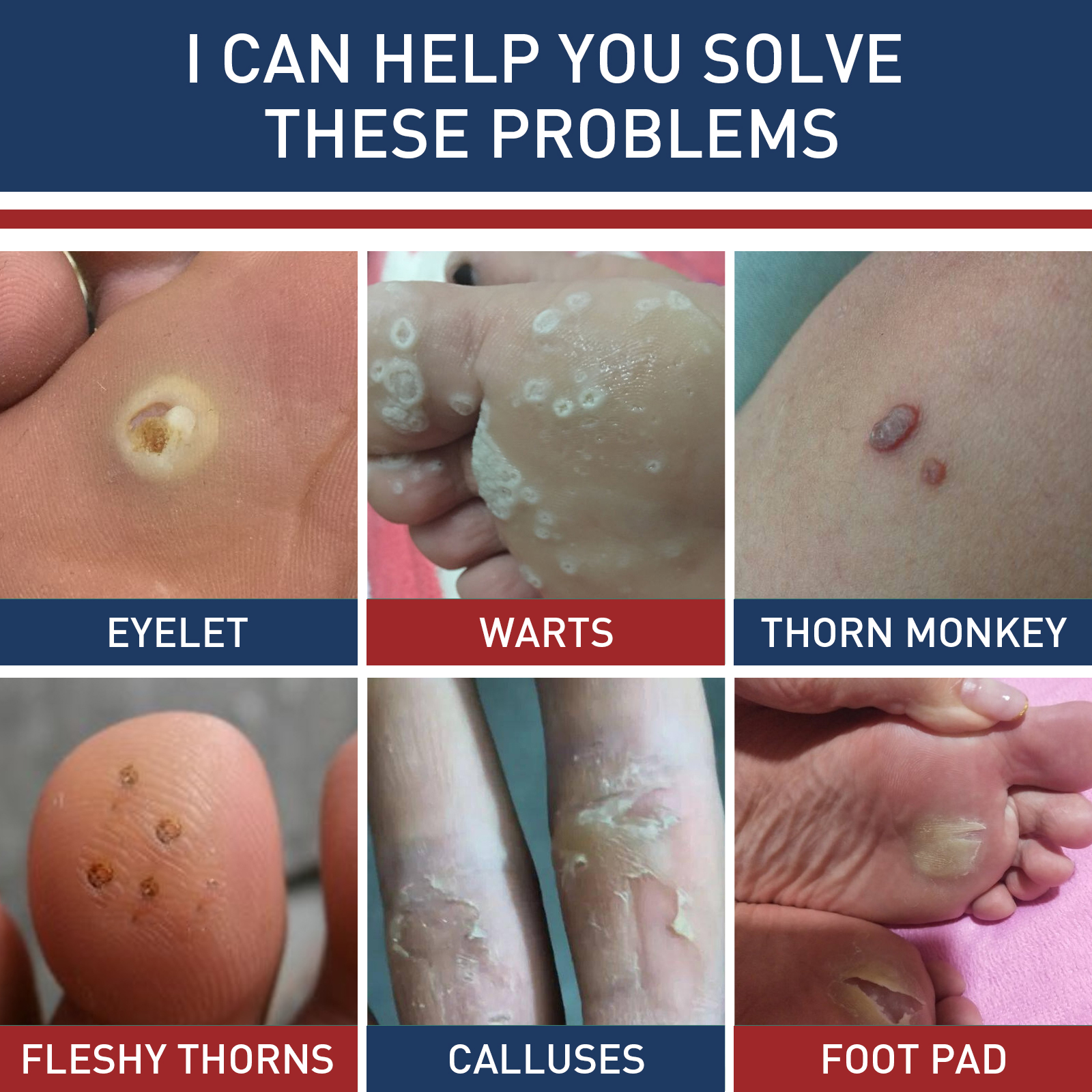 24Pcs Foot Toe Corn And Callus Removers Pads Self-Stick Adhesive Foot Cushion Corn Callus Remover Cushions Foot Care Patches