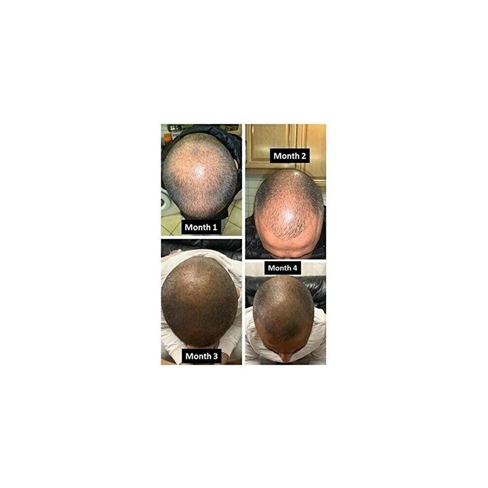 Hot Seller Neo Hair Lotion Herbs 100 Natural Treatment Spray Stop Hair Loss Root Nutrie