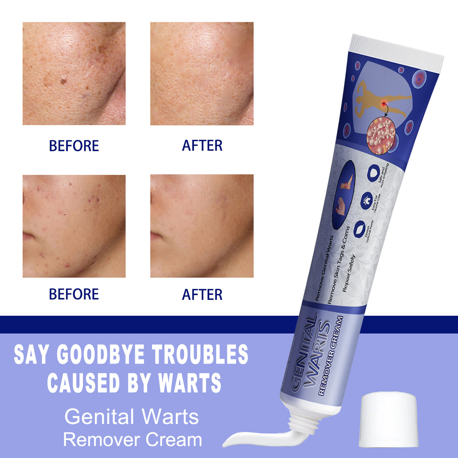 South Moon Skin Tag Remover Liquid Kit Wart and Tag Remover Wart Remover Fast Acting and Painless  for Body Anti Acne Face Cream Natural Safe Mole Remover
