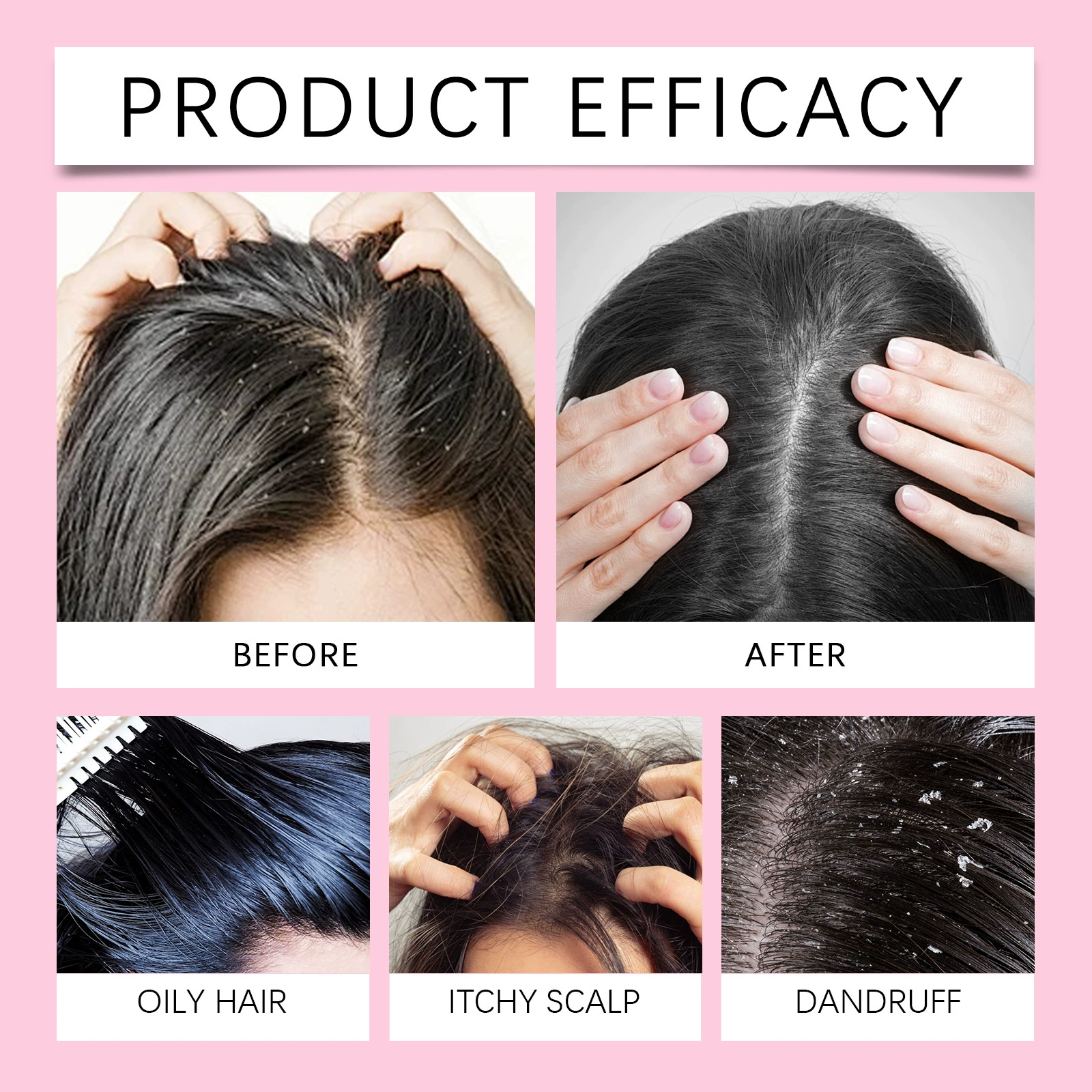 Scalp Scrub Onion Scalp Exfoliating Shampoo For Purification And Removal