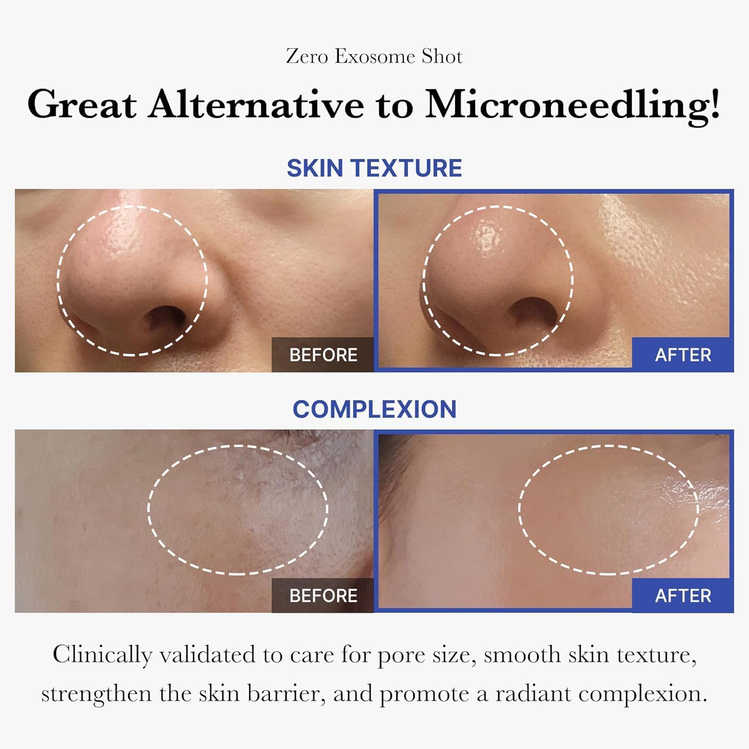 medicube Zero Exosome Shot 2000PPM Spicule Face Serum 30ml Liquid Skin Booster Serum Exosome AHA BHA PHA Pore Care Dead Skin Cells Skin Texture Korean Skin Care