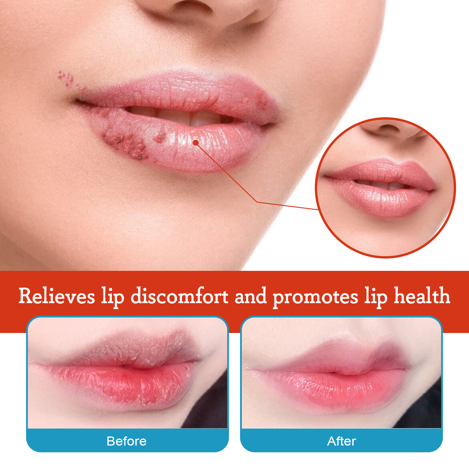 Cheilitis Treatment Cream Lip Cream Cheilitis Type Dressing Moisturizing Brightening Wrinkles Reducing Lip Repairing Cream