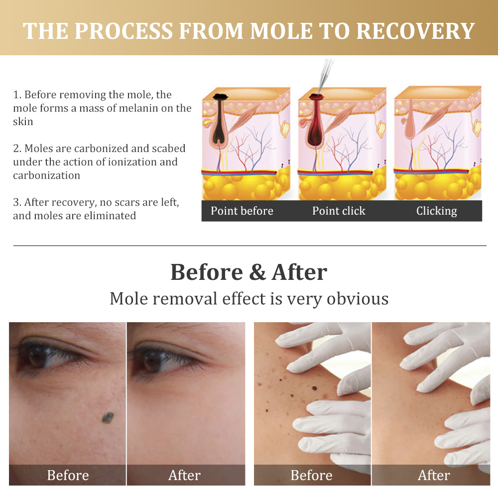 Black Spot Wart Removal Pen Skin Label Removal Laser Plasma Pen Tattoo Mole Spot Freckle Remover