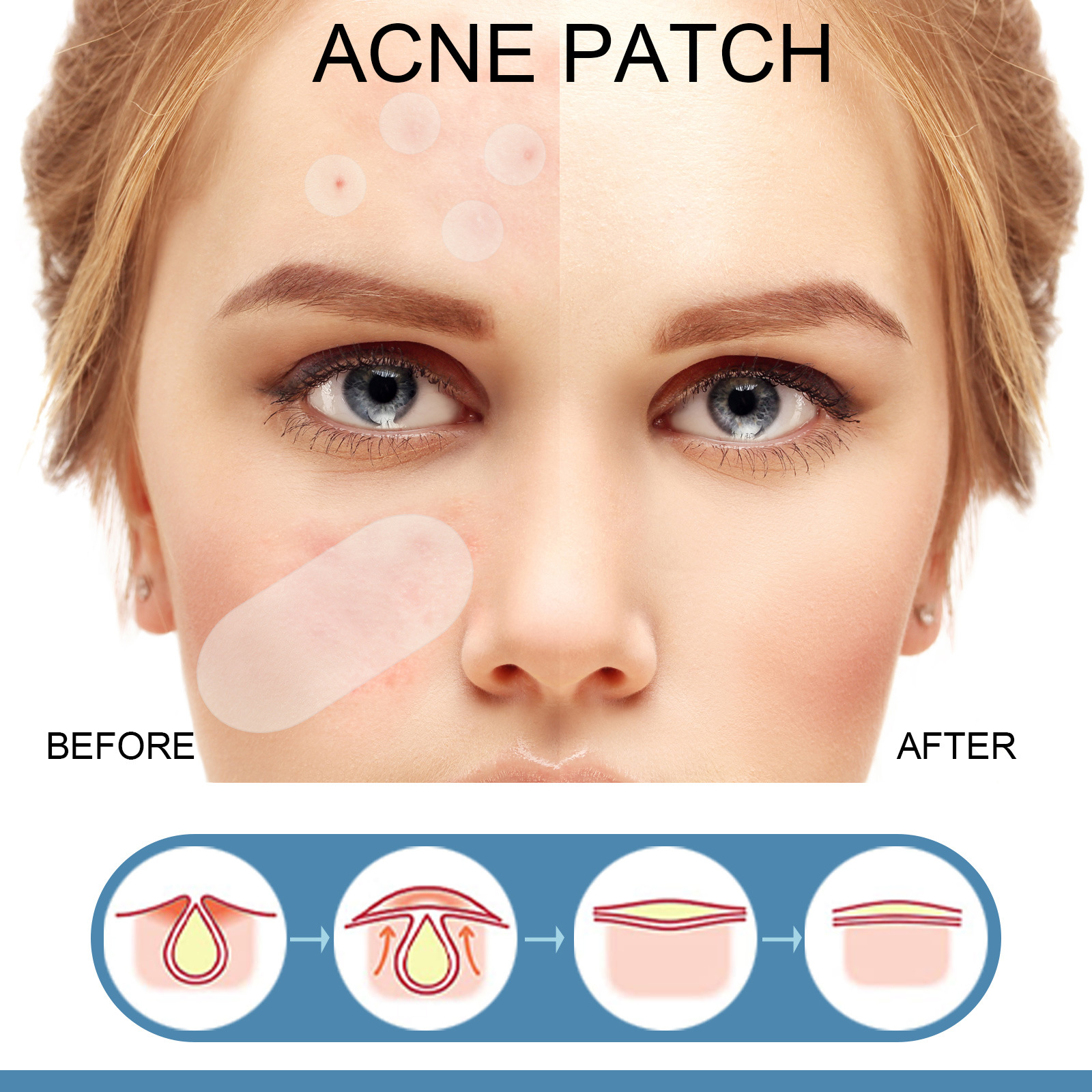 80Pcs Large Size Acne Patches Removal Pimple Anti Acne Hydrocolloid Bandage Patches Spots Marks Concealer Repair Sticker Skin Blemish Remover Skin Care