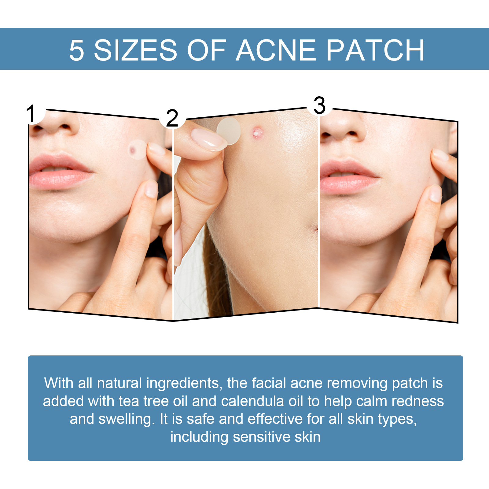 80Pcs Large Size Acne Patches Removal Pimple Anti Acne Hydrocolloid Bandage Patches Spots Marks Concealer Repair Sticker Skin Blemish Remover Skin Care