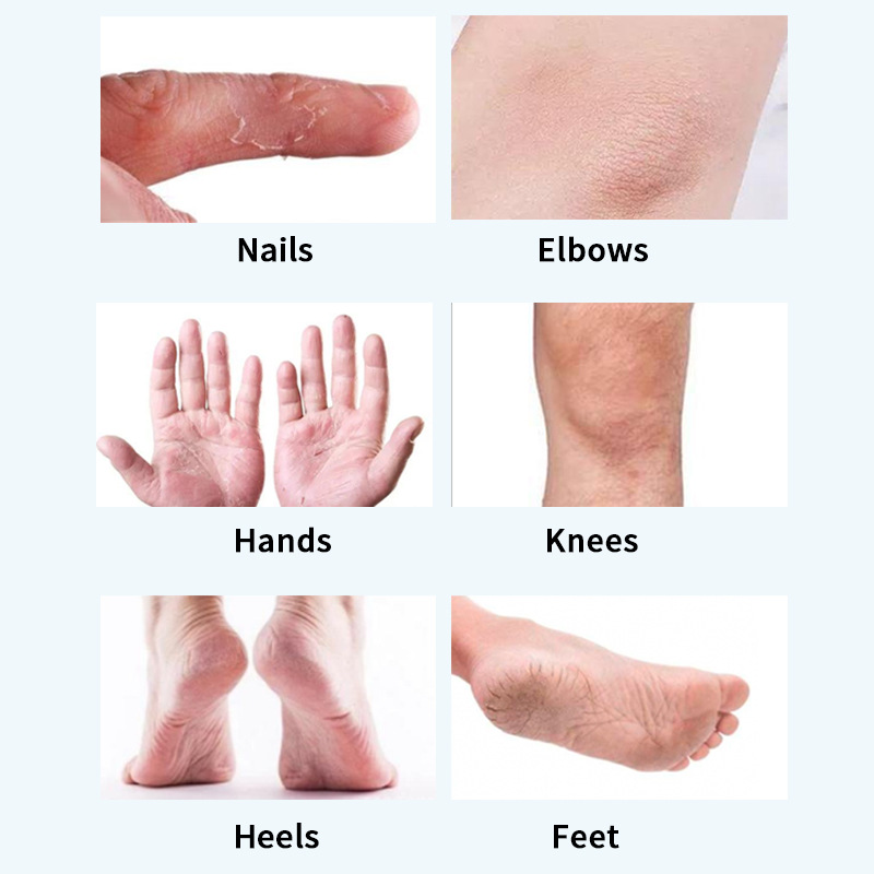 Urea Foot Cream For Cracked Heels Dry Skin Moisturizing Repairing Daily Foot Care Treatment 50g