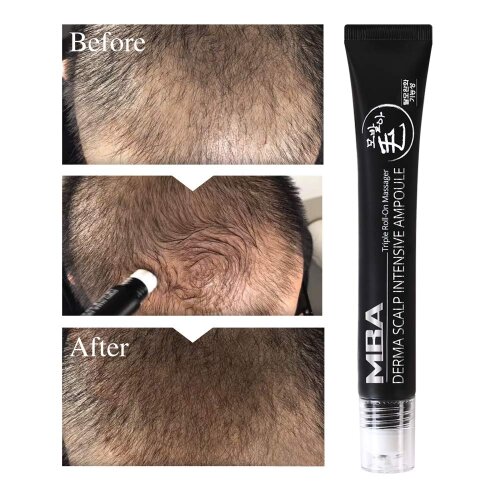 MBA MoBalA Derma Scalp Intensive Ampoule Hair Line Growth Serum Derma Scalp Triple Roll Hair Anti Products Hair Essence Massager Regrow Loss Hair Fast 20ml