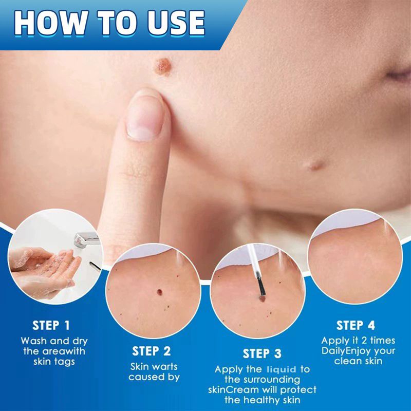 iBeaLee 20ml Skin Tag Remover Fast Effective Safe