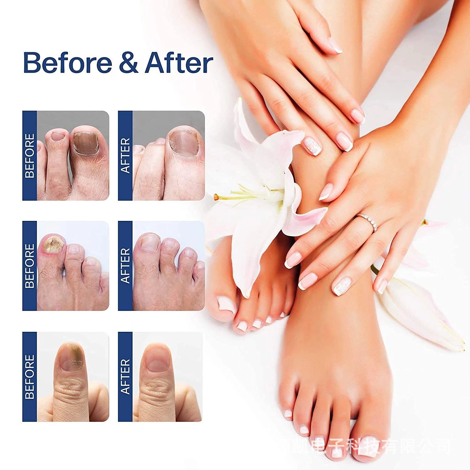 SUAI Nail Fungus Treatment Repair Liquid Foot Essence Serum Feet Care Products Anti Infection Onychomycosis Paronychia 20ml