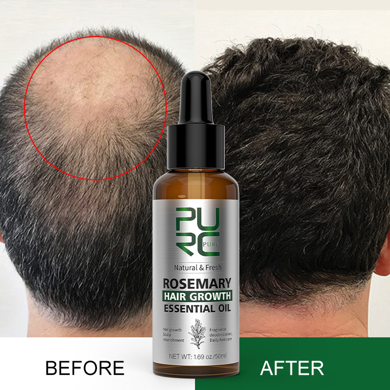 PURC Rosemary Oil Hair Growth Products for Man Women Ginger Anti Hair Loss Fast Regrowth Thicken Essential Oils Hair Serum   Scalp Treatment Hair Care