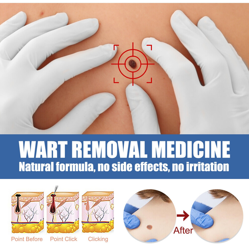 WART REMOVER OINTMENT SKIN TAG NATURAL TREATMENT MOLES SAFE VERRUCA 20g