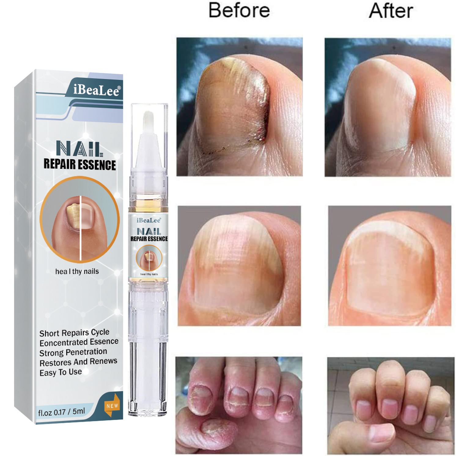 iBeaLee Nail Repair Essence Fungus Treatment Pen Fungus Stop Pen Toenail and Nail Care Solution