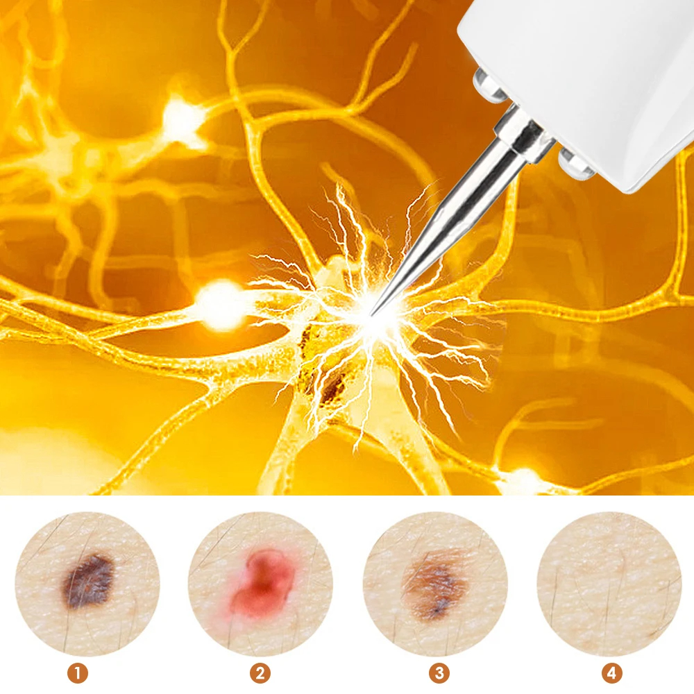 Freckle Dark Spot Mole Pen Blue Light Ionized Carbonization Repair Electric Salon Special Remove Skin Tag Fat Grain Warts Berrugas Eliminator Plasma Pen
