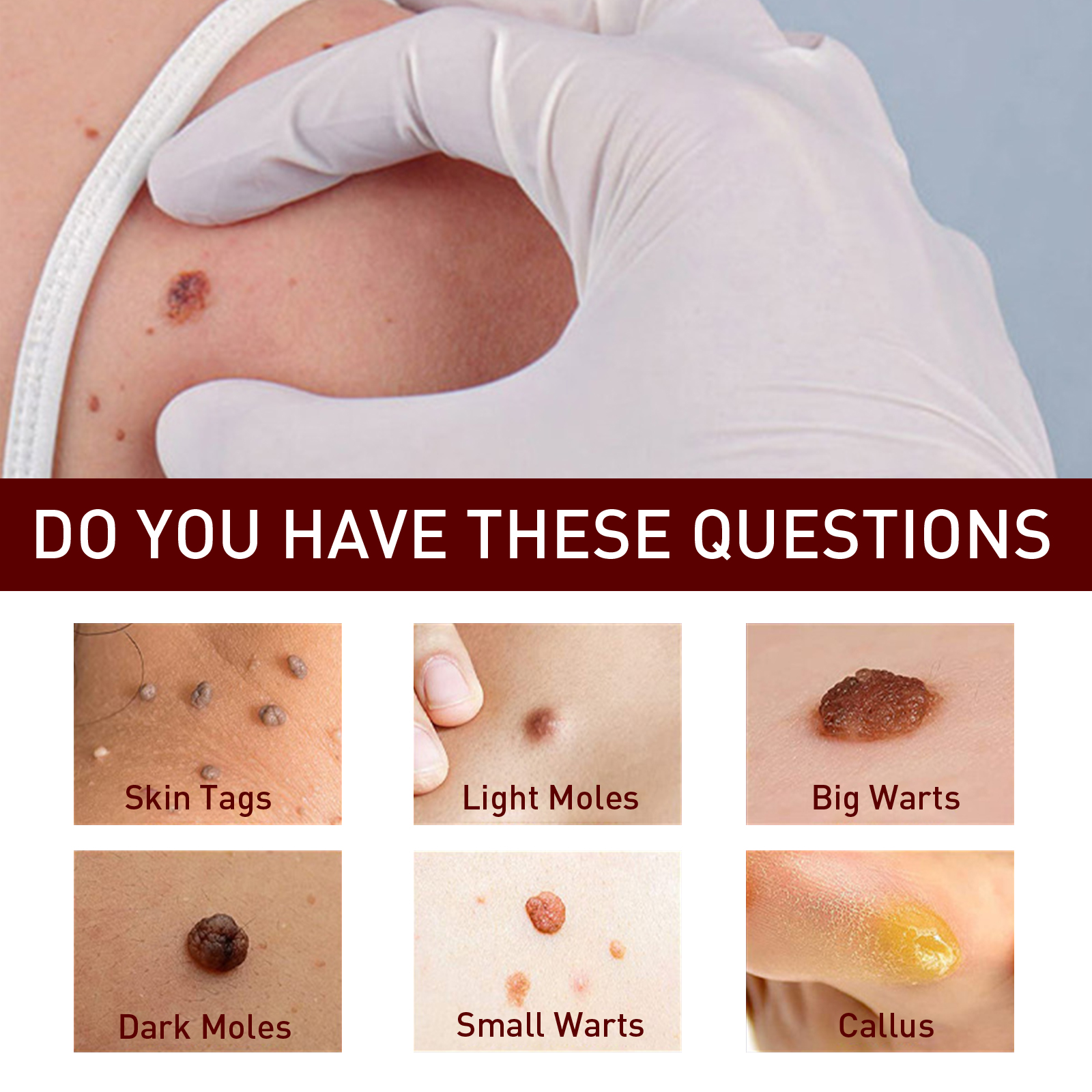 Body Care Pen Skin Tag Remover Cleansing Warts Corns Softening Keratin For Smooth Skin Daily Treatment