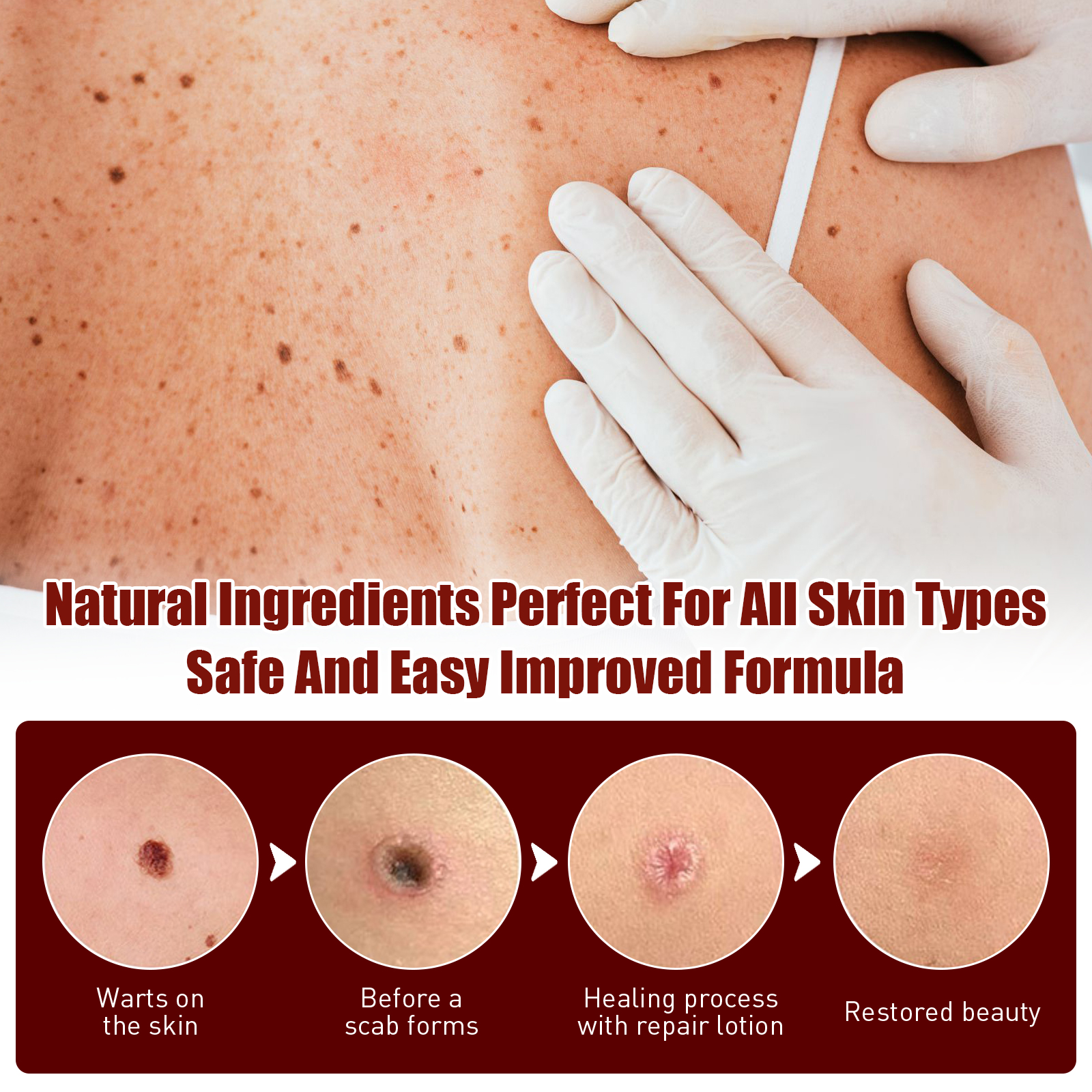 Body Care Pen Skin Tag Remover Cleansing Warts Corns Softening Keratin For Smooth Skin Daily Treatment