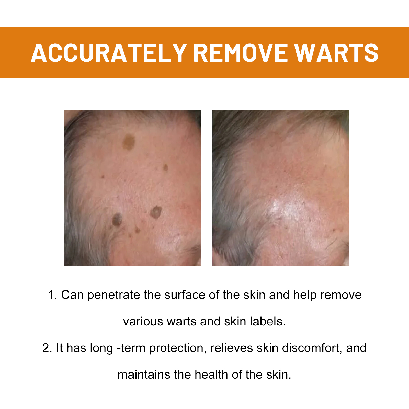 Bee Venom Skin Tag Remover Spray Cleansing And Repairing For Warts And Corns Daily Care Treatment 1 PCS