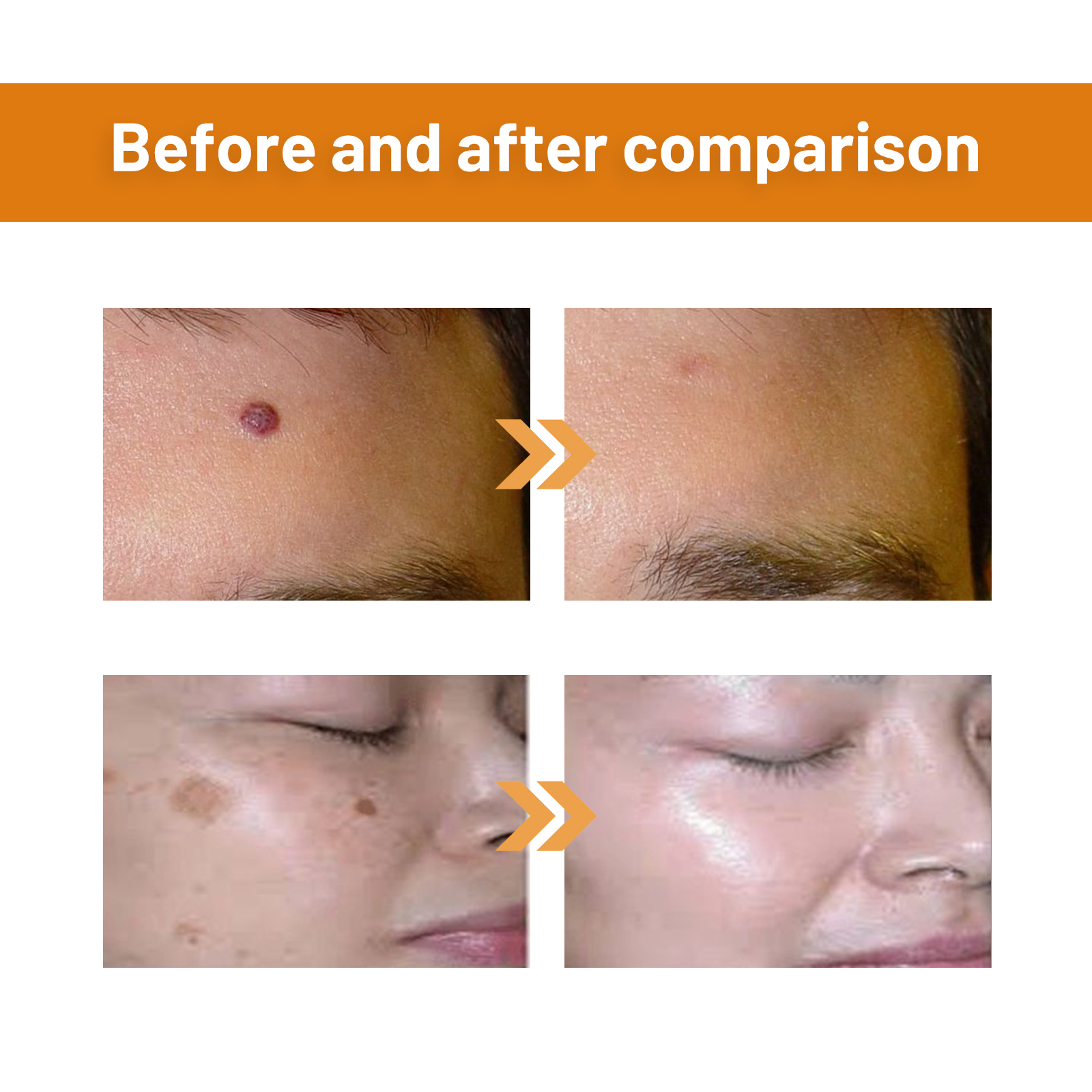 Bee Venom Skin Tag Remover Spray Cleansing And Repairing For Warts And Corns Daily Care Treatment 1 PCS