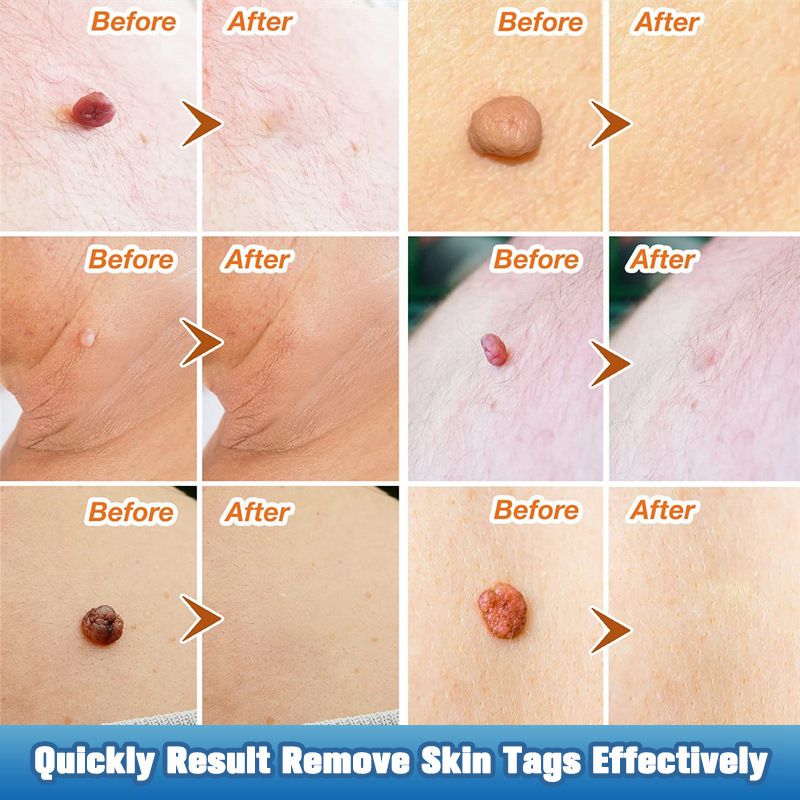 iBeaLee 20ml Skin Tag Remover Fast Effective Safe