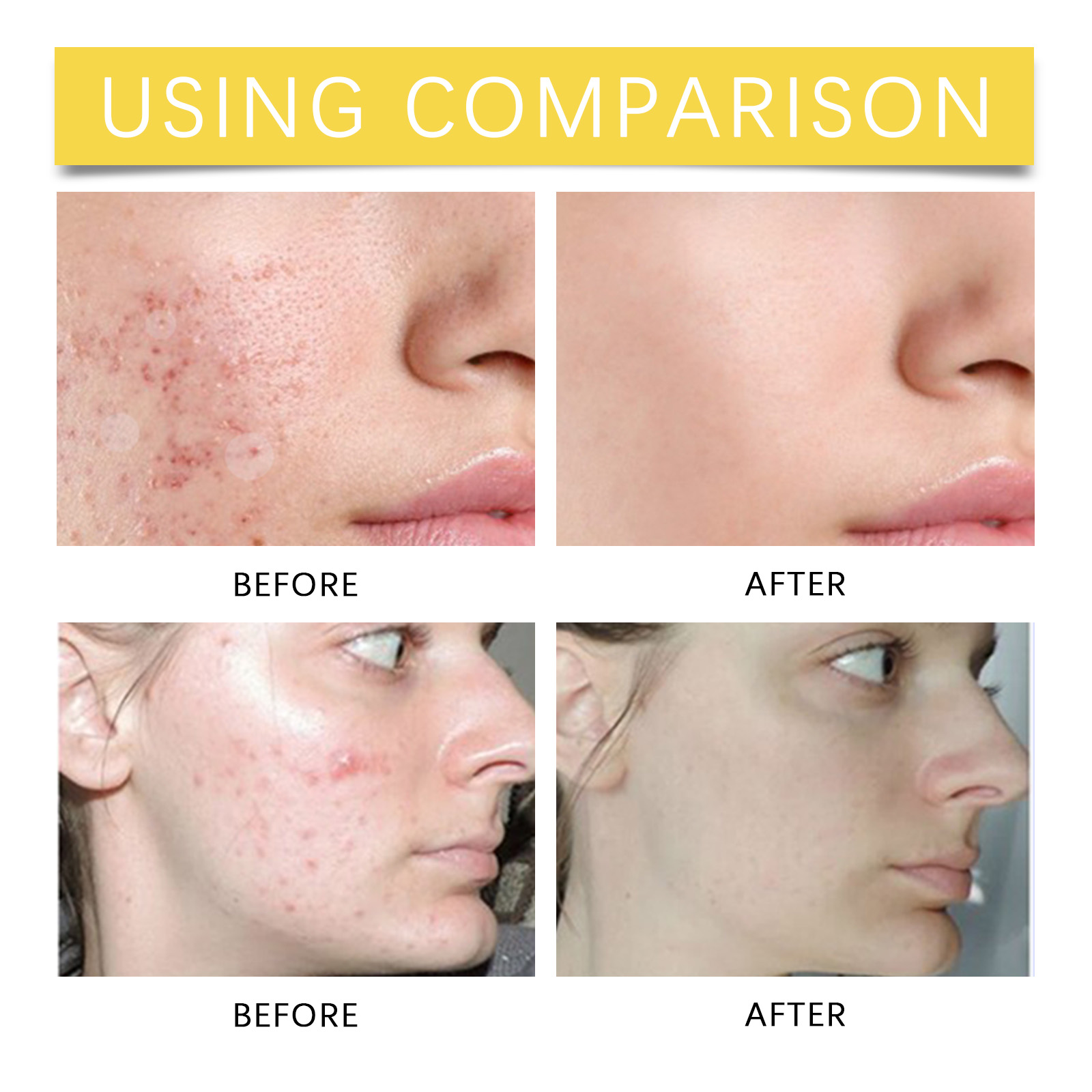 Star Shaped Facial Acne Patch Acne Clearing Skin Care Invisible Cover Facial Care Pimple