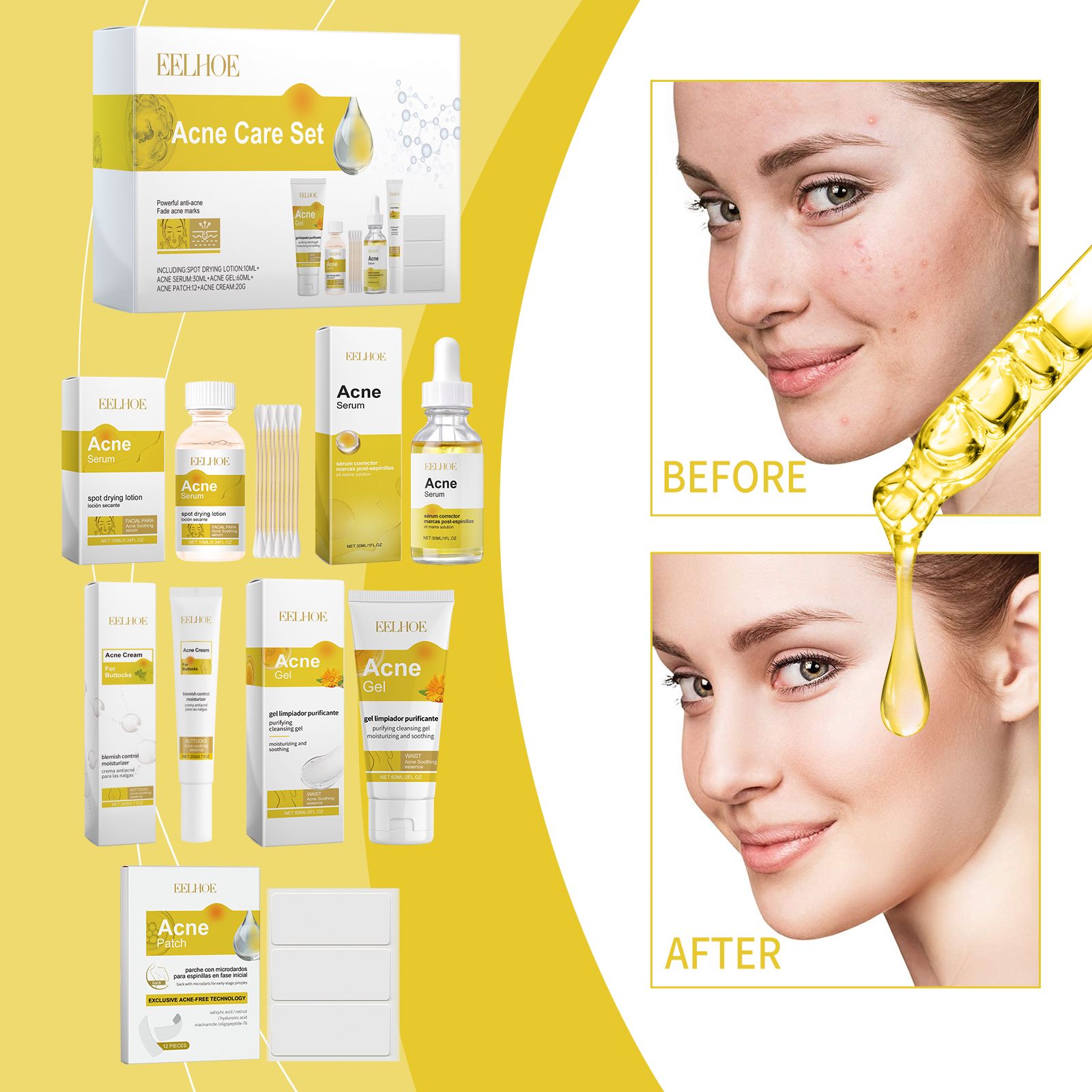 Acne Prone Skin Care Set With Essence Gel Cream And Patches For Daily Blemish Care