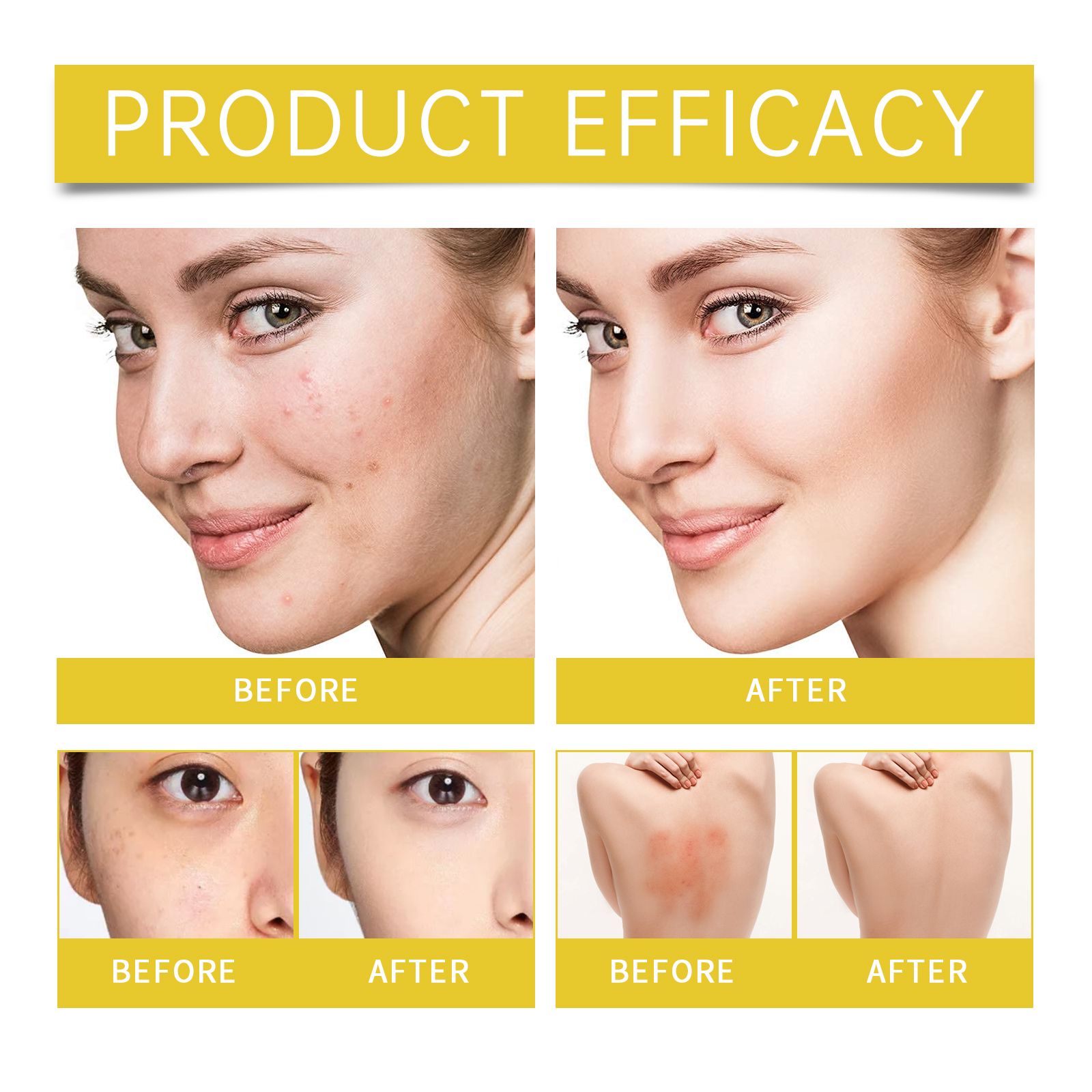 Acne Prone Skin Care Set With Essence Gel Cream And Patches For Daily Blemish Care
