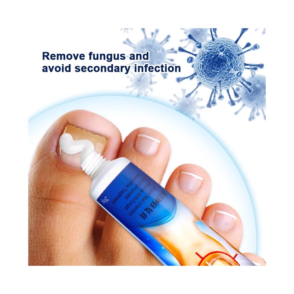 Herbal Toe Nail Fungus Treatment Cream Onychomycosis Paronychia Antibacterial Anti Fungal Infection Repair Ointment
