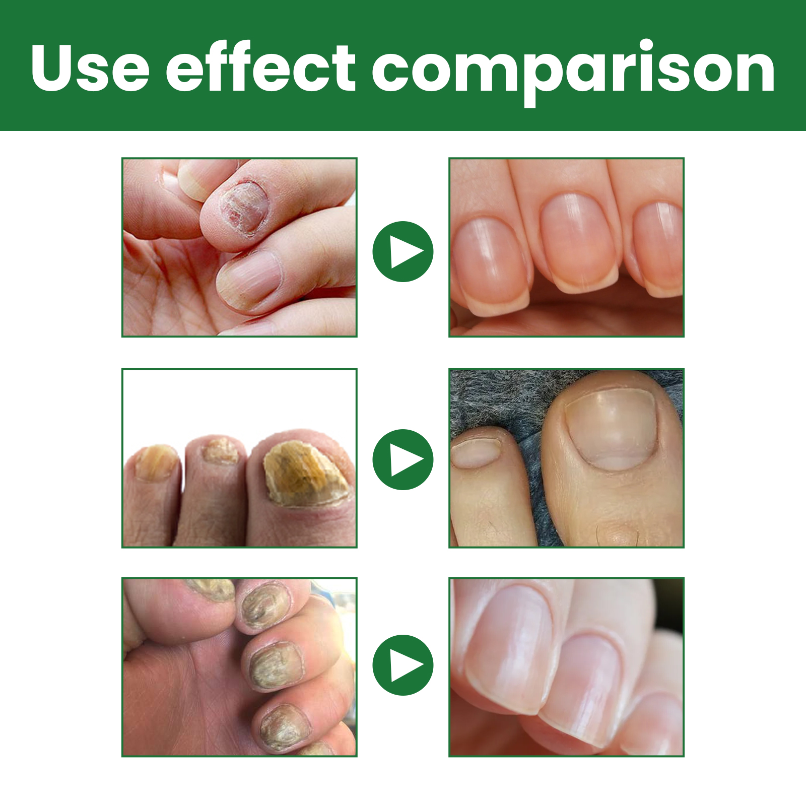 Nail Fungus Treatment Liquid Restoring Strengthening For Toenails Fingernails Daily Home Care 30ml