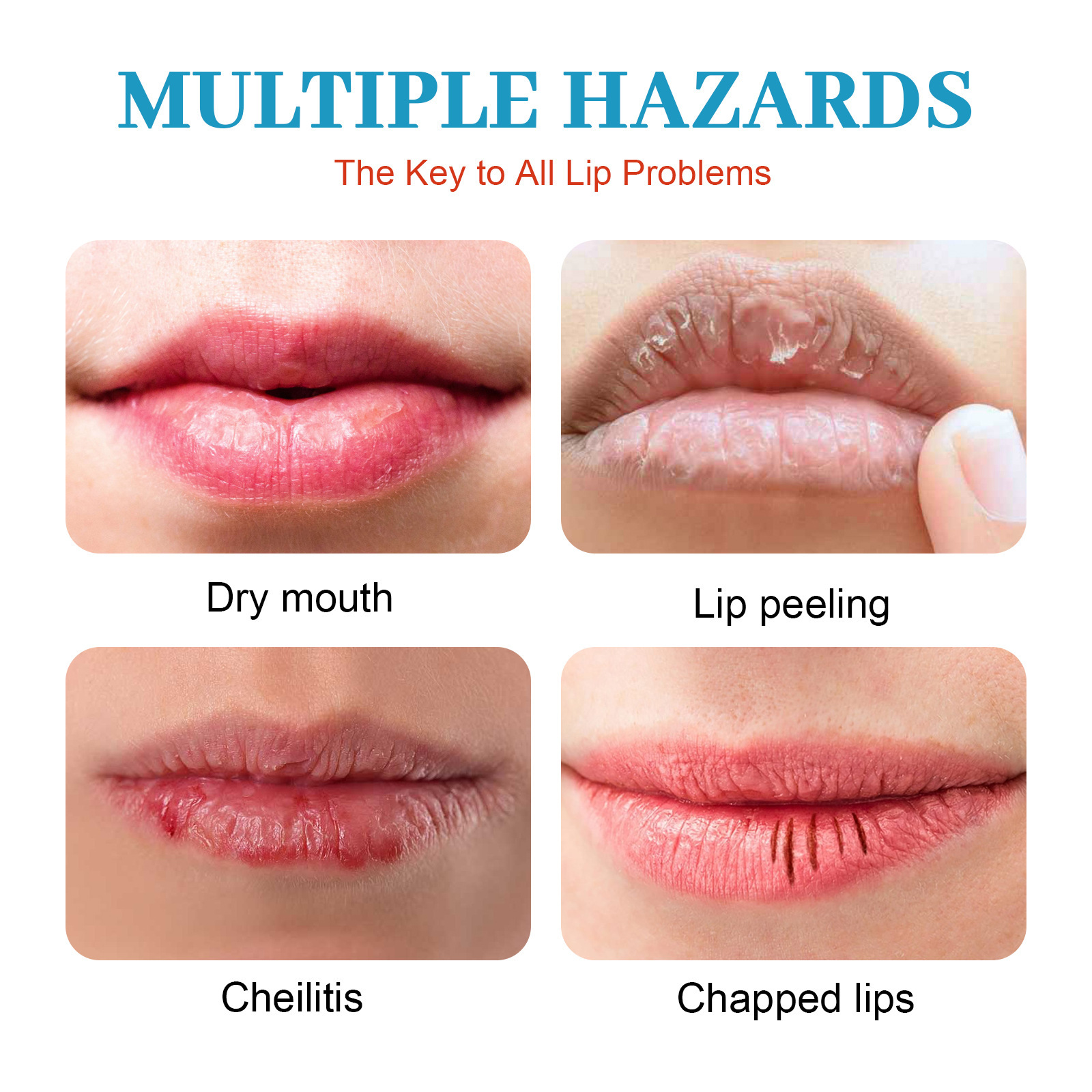 Cheilitis Treatment Cream Lip Cream Cheilitis Type Dressing Moisturizing Brightening Wrinkles Reducing Lip Repairing Cream