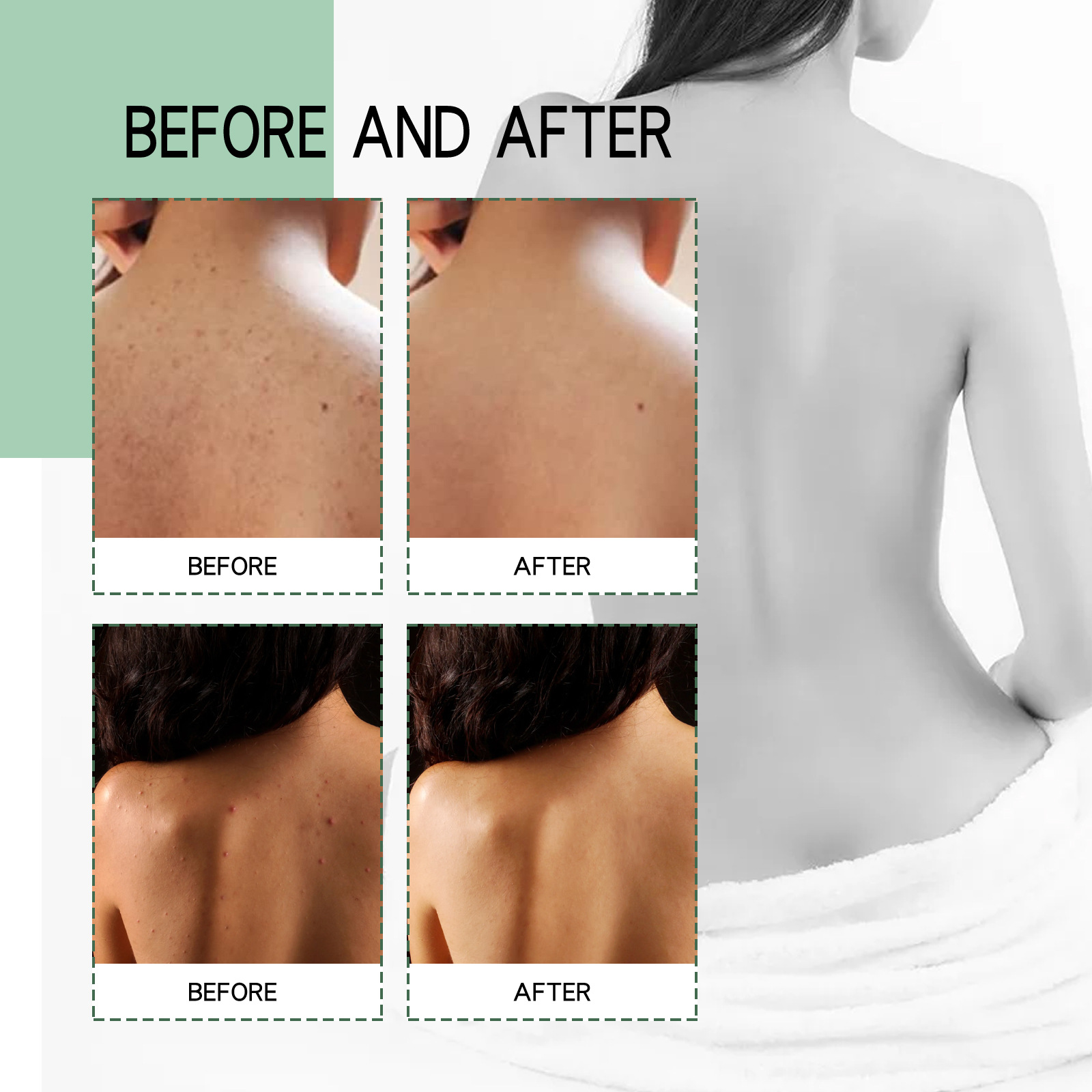 (1 PC) Body Acne Removal Cleanser Spray for Back and Arm Anti-acne Water Oil Balance Remove Redness Shrinking Pores Clean Body Pimple Remover Spray