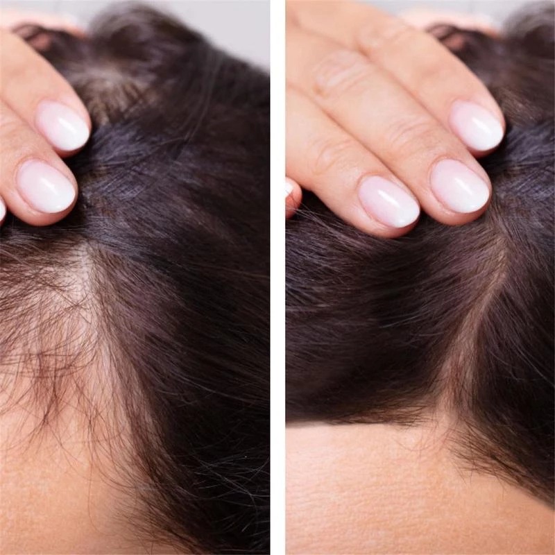 Hair Growth Essential Oil Ginger Hair Lost Solution Serums Fast Scalp Hair Care Treatment For Men Women 20ml