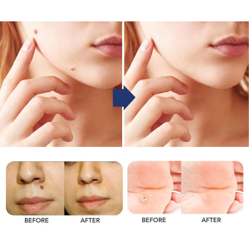 Skin Tag Remover   Skin Tag Remover Serum  From
